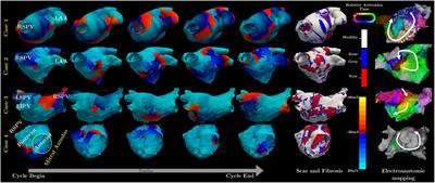 Case report: Personalized computational model guided ablation for left atrial flutter